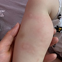 宝宝这几天腿部老是长这些东西，每次都要抓到流血🩸才停下来😂😂有那位宝妈知道是被啥东西咬我的