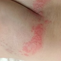 现在正是夏天最热的时候，宝宝这几天突然长了这个，没办法还是要穿纸尿裤。54天小宝宝。昨晚上只涂...