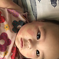 有知道这是什么问题的朋友吗，去了医院好几次都没有弄好，过敏，有没有什么涂的药可以治好，