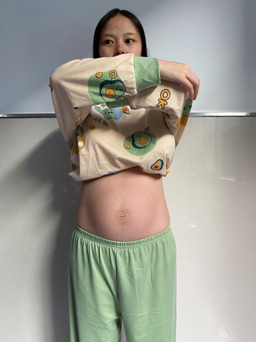 产后八小时的肚子，有点心疼自己，虽然没纹，可是肚子还是变了形。