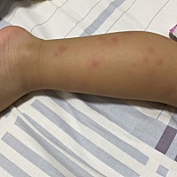 每次发烧后，身上就长这些小红点，是正常现象吗？
