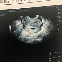40天的彩超，医生什么也没说，就说都挺好。是双胎吗？