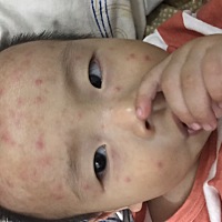 有没有宝妈知道这脸上长的什么，脸上耳朵后面有。身上没有。