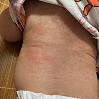 痱子➕湿疹，医生开了药擦了几天好了，老是反反复复😫😫😫