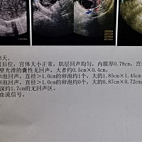 两个卵泡是否太大？大的为什么还不排？