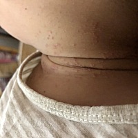 求助!1岁9个月宝宝脖子上长的啥？ 痱子？湿疹？还是其他皮肤病？ 擦了一个月桃子水，无效；接着擦了一个...