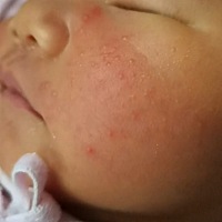 俺妞脸上出了好多米痘痘是什么情况呀？有经验的宝妈，帮忙来指点一下😿