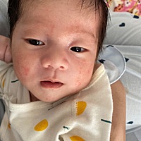 出生的时候没有 现在23天 脸上脖子里都长了好多  愁死了