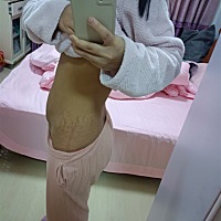 有没有什么去妊娠纹的好产品