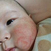 都怪我心太大，儿子湿疹严重成这样了才开始引起重视！折磨他大半个月，每天都会把脸抓破，烦躁不安，哭...