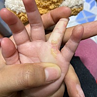 小女儿两周岁半 手指从出生就有这样的疙瘩 看过医生说等年龄大一点可以激光祛掉。目前不痛不痒 想问一下...