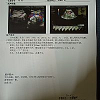 双顶径79，股骨长57，看着像男孩、女孩？