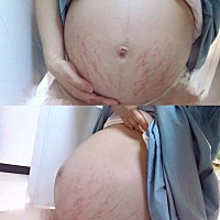 不是托，但真的挺好用的(苹果原相机拍的，没用任何美颜) 仔细看图片就知道，纹路都是一样的，但确实淡了...
