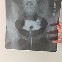 之前有过怀孕 但是最近两年没有 原本以为就是多囊 结果让我做一个输卵管造影结果是右边完全不通 左边通 ...