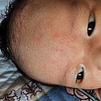 孩子出生半个月脸上长这些小疙瘩，半个月了都没下去，宝妈们有知道这是什么的吗？