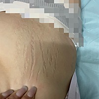 娃都快两岁了还是无法正视这可怕的妊娠纹…