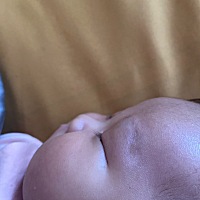 两个月的宝宝，一开始眉弓发青，现在肿了，按压肿处宝宝没有疼痛反应，眉毛上稍有黄痂，有相同经历的宝...