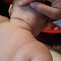 宝贝六个月了，突然起的很红，涂了药高也没有消下去