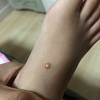宝宝脚上长了疹子，是不是传染性软疣？