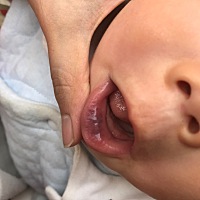 宝宝7个月了，突然发现下嘴唇中间紫黑色，有哪位宝妈知道是什么问题吗？网上搜说心肺问题，也有说是心脏...