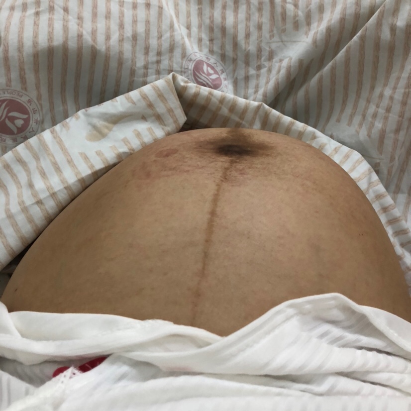 6.22号人工破产肚子鼓鼓的最后一张照片