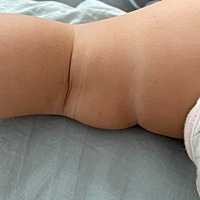 大腿和脖子肉肉褶皱颜色都不一样 脖子和腿一块白斑是湿疹引起的 皮肤色差好大 也没有涂激素药膏 怎么破