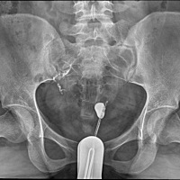 这种情况要怎么办啊输卵管有一边高哎