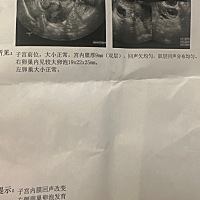 月经第13天 今天又是右侧大卵泡19×22×25（左侧输卵管不通）其实每次都在右边运气真的很好，所以希望这...