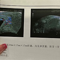 现在报告上都没写是双胎 看着是单胎 但是我看着有两个点点 谁来帮我解答一下呀