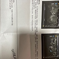 子宫内膜息肉要怎么办好？医生建议做宫腔镜，但是我不想 ，想药物治疗，要怎么办好？求广大网友给个建议