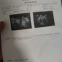 这是排卵了吗宝妈们