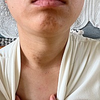 麻烦大家告知一下治疗甲状腺结节的办法，哺乳期，情绪非常不好，三类结节，囊实性的