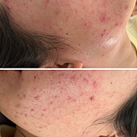 来大姨妈肚子疼怎么还有犯恶心🤢没胃口正常吗？还长痘痘😭