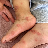 卫生院抽血化验结果说是胞疹病毒感染引起的，然后也用了好久药不见好，然后小诊所说这个是虫子咬了引起...