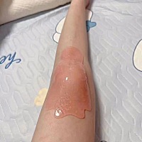 不知道有没有同款宝妈生了孩子以后有了炎症跟糜烂，反反复复的跑了好几个医院都好不了，太头疼了