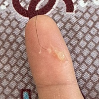 例假刚走 就出现这个 是不是妇科病啊 好担心