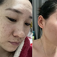 看看刚生完孩子脸成啥了，还嫌弃上我了，不是为了给你生孩子我也不会这样 一年了姐妹帮我看看这个改变还...