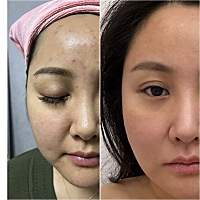 怀孕胖了不说，结果痘痘还多，最后他天天厌烦我，每天我做什么都不顺眼，现在孩子大了，我也对自己下了...