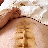 剖腹产的疤痕增生了，现在能恢复这样一点白白的印我已经很满意了 剖腹产的疤增生了，好在终于消下去了，...